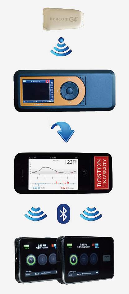 Illustration of the bionic pancreas system