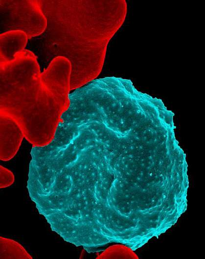 Malaria-infected red blood cell.