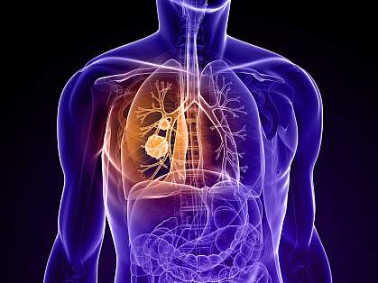 Diagram of a torso with a tumor in the lung