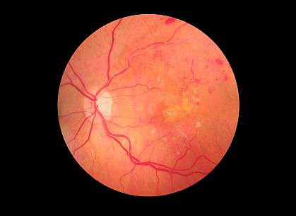 Retina Test, Fundus Checkup, Dilated test, Diabetes in retina