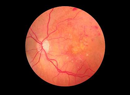 Medical photo of retinopathy
