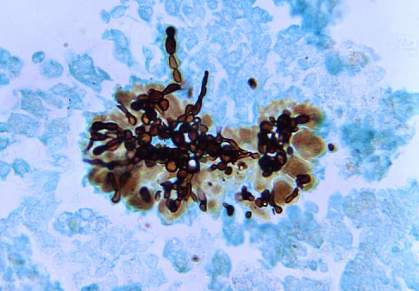 Photomicrograph of liver tissue specimen with dark chains of fungi.