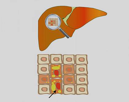 Illustration of a liver with old cells filled with fat