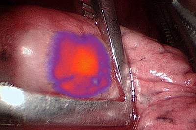 Malignant pulmonary nodule glowing during surgery