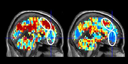 Brain scans show different patterns between people who had attempted suicide and control participants