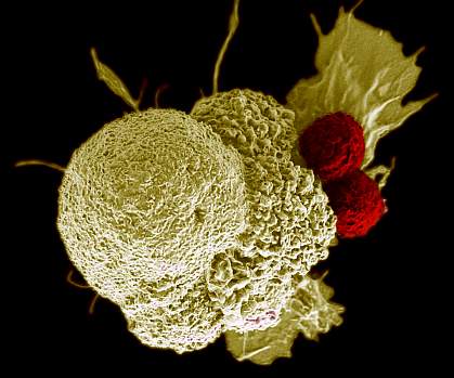 Scanning electron micrograph of a cancer cell being attacked by two T cells