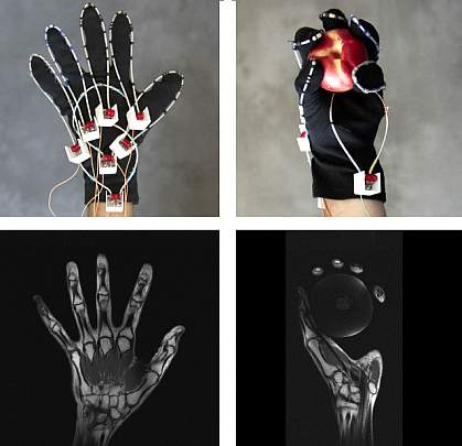 Photos of MRI glove on hand and MRI scans of the hand 