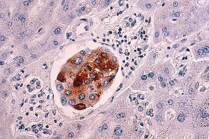 Malignant breast cancer cells in liver