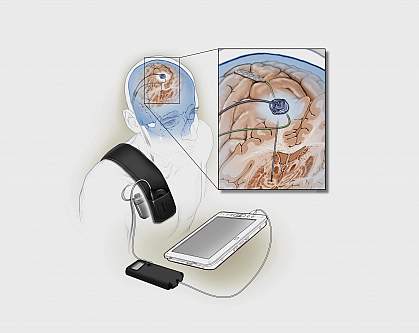 Illustration of implanted deep brain stimulation device