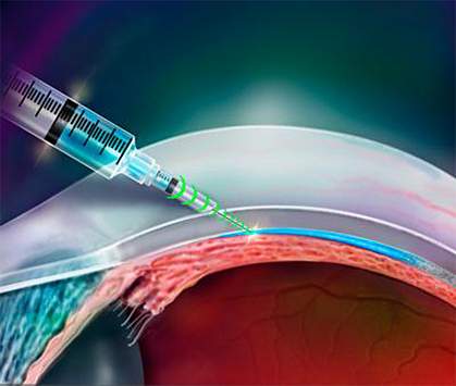 Illustration of resistance-sensing injector being used in an eye
