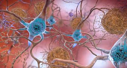 Illustration of nerve cells with plaques and tangles