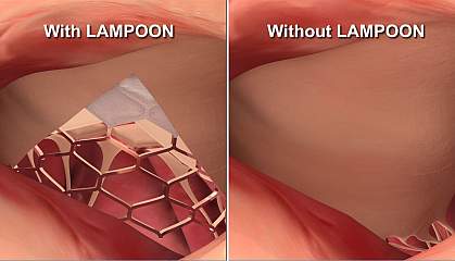 Illustration of heart valve leaflets with and without LAMPOON