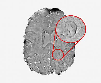 Brain MRI image highlighting a lesion with a dark outer rim