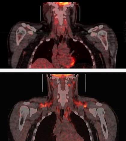 Brown fat activation