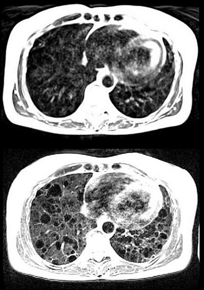 MRI scans
