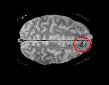 Brain scan showing microbleeds