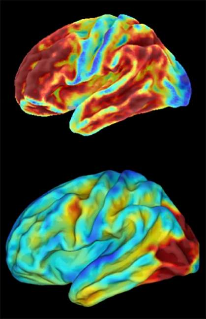 Brain images of woman with inherited condition that causes early-onset Alzheimer’s disease 