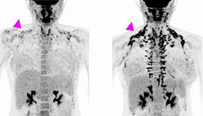 imaginile PET ale trunchiului unei femei arată o creștere mare a grăsimii brune după 28 de zile.