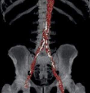 Schematic of aortic calcification in CT scan