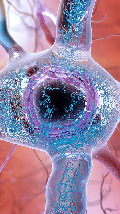 Illustration of tangled tau threads in a neuron