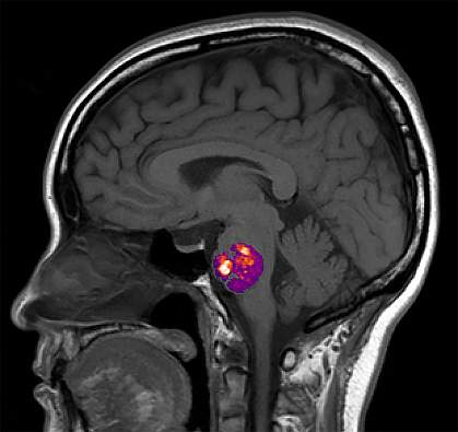 Cavernous angioma on brain scan