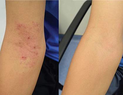 Photos of elbow with eczema before treatment and without eczema afterward