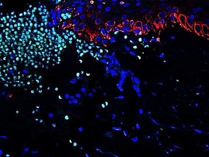 Neutrophils in acute human skin wound