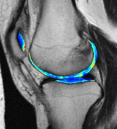 MRI of knee cartilage