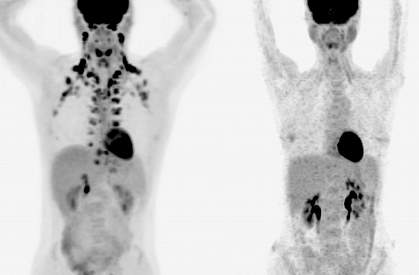 PET scans with brown fat