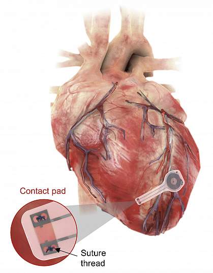 Temporary pacemaker mounted on the heart. 
