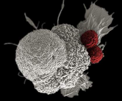 Scanning electron micrograph of cancer cell being attacked by T cells