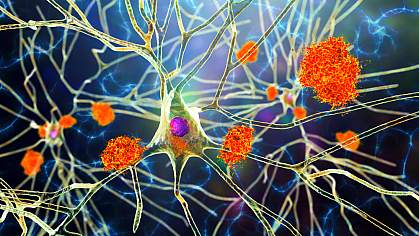 Illustration showing clumps of amyloid around a branched neuron