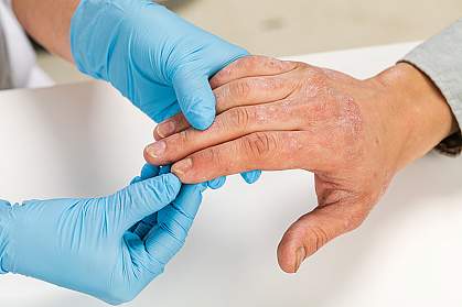 Dermatologist wearing gloves examines the skin of a patient with eczema