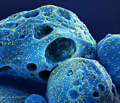 Cell with numerous SARS-CoV-2 virus particles