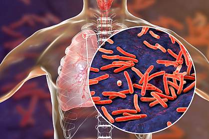 Mycobacterium tuberculosis bacteria in lungs.