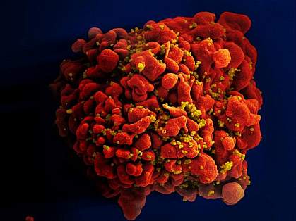 Scanning electron micrograph of an HIV-infected T cell.