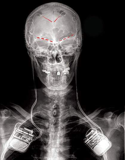 X-ray shows recording devices in both shoulders with electrodes at the top of the brain and above the eye sockets.