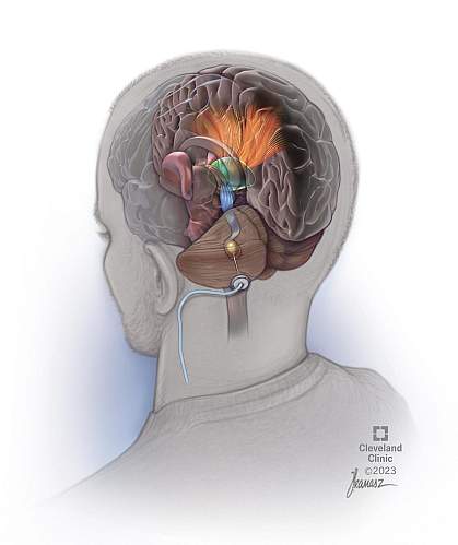 Illustration showing a lead implanted in the lower rear of the brain and stimulating nerves that connect to other brain regions.