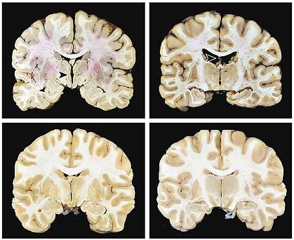 The top left image shows a notch at the center of the brain; the top right image shows a void near the upper center. Both abnormalities are absent in the control brain images.