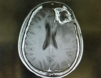 MRI of a gliblastoma.