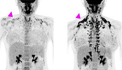 PET images of brown fat in woman’s body showing more brown fat on day 28 in regions between neck and shoulders.