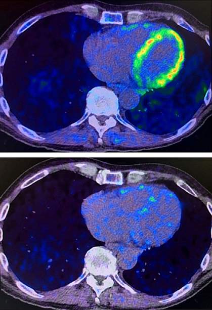 Heart PET scans from a study participant.