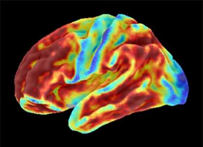 Brain image of woman showing large red areas.