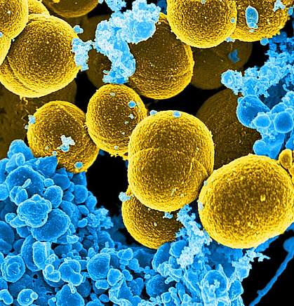 Spheroid shaped, Staphylococcus aureus bacteria surrounded by white blood cells.