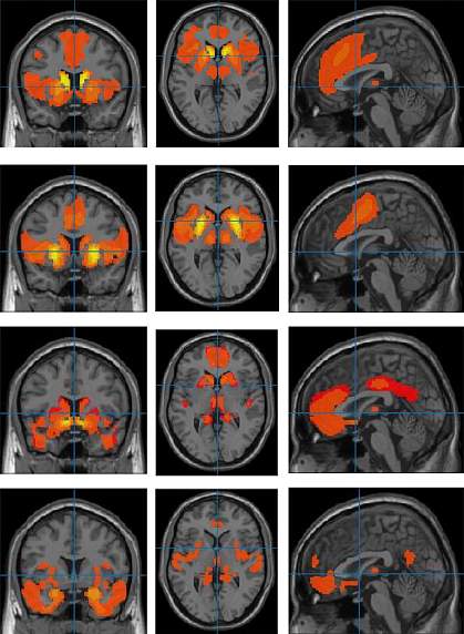 Brain images with red and yellow areas.