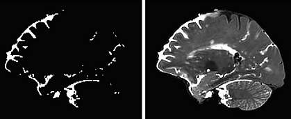 Side view showing perivascular spaces highlighted throughout a human brain.