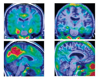 Four tau PET brain images show larger areas of red in left two images