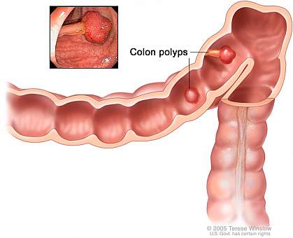 Illustration of colon polyps.
