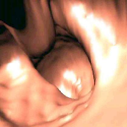 Screen shot from a virtual colonoscopy video.
