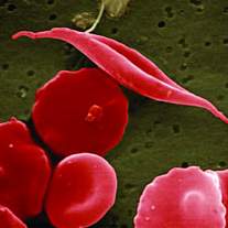 Sickle cell disease (SCD)
